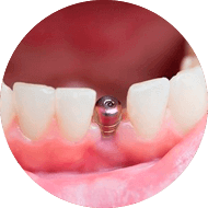 Импланты зубов виды и цены 2024