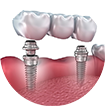 Имплантация трех зубов