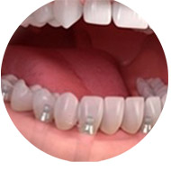 Полная имплантация всех зубов