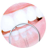 Срок службы службы зубных имплантов