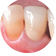 Зубной имплант не прижился — что делать?