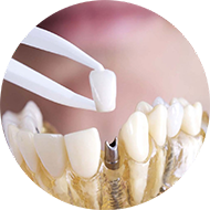 Какие есть альтернативы имплантации зубов