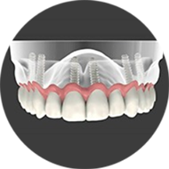 Комплексная имплантация зубов