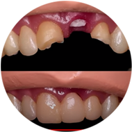 Методы восстановления передних зубов