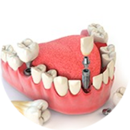 Как долго приживаются импланты зубов