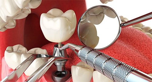 Узнайте, какие факторы влияют на стоимость имплантации зубов