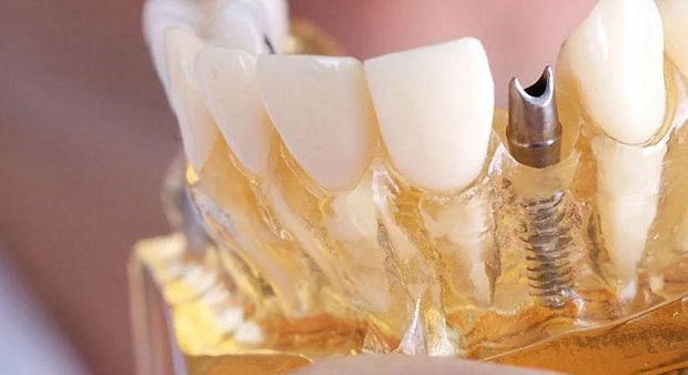 виды имплантации передних зубов