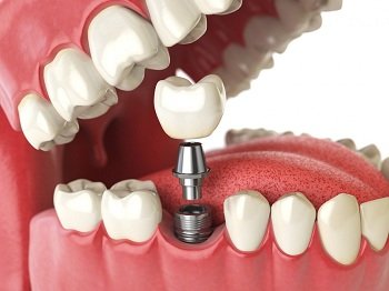 Имплантация зубов: основные разновидности имплантов