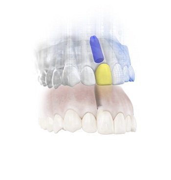 Зубные импланты Astra Tech
