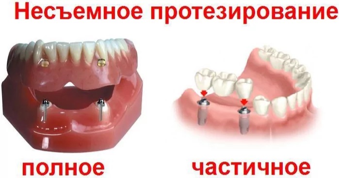 На фото — виды несъемных зубных протезов