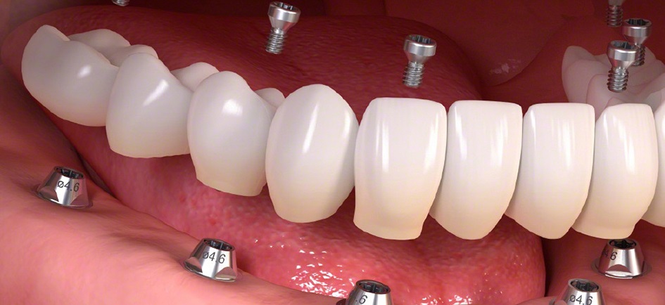 Несъемные протезы зубов