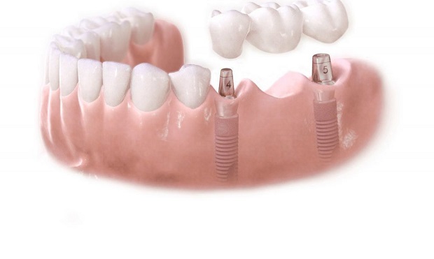 имплантация жевательных зубов